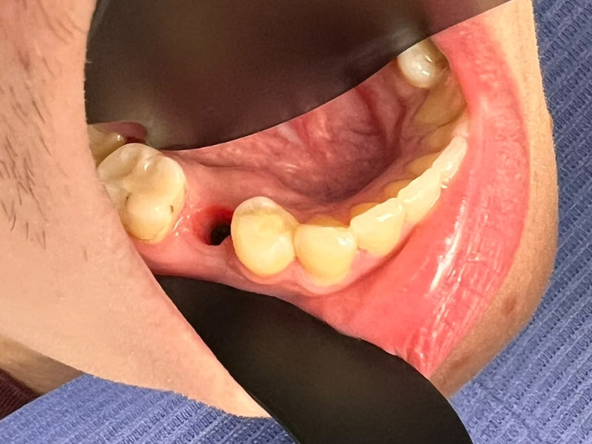 Dental implant procedure step 1 – preparation of the implant site in the gum Smile Centrum