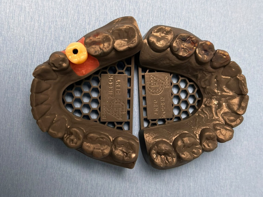 Zavedení zubního implantátu krok 3 – příprava a skenování pro výrobu stálé korunky