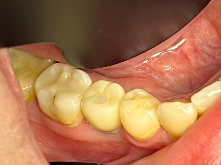 Zavedení zubního implantátu krok 5 – finální nasazení stálé korunky po 3 měsících Smile Centrum